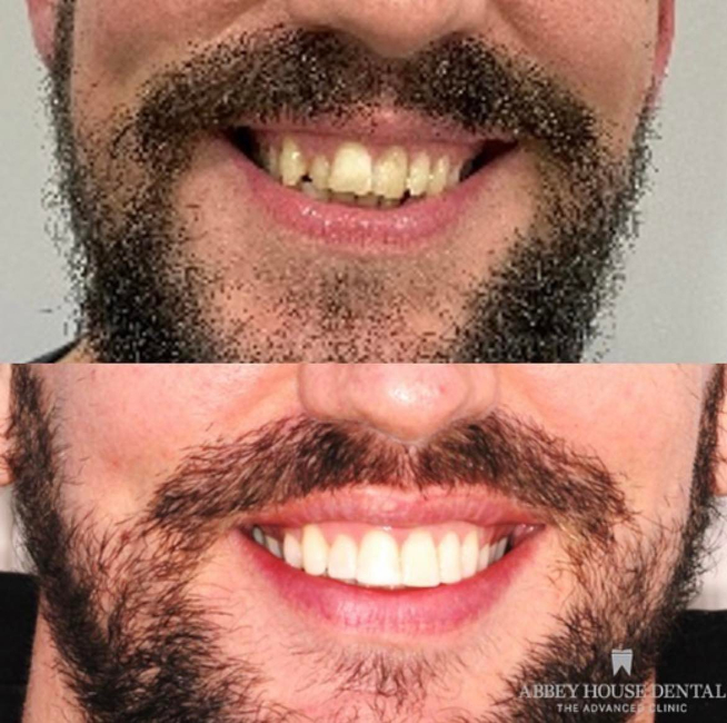 Before and After - Comp Bonding Invisalign and Whitening