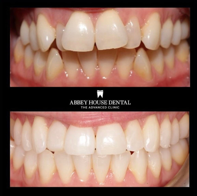 Before and After - Invisalign