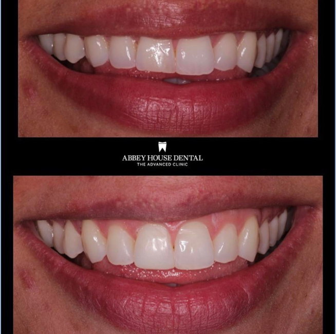 Before and After - Full Arch Comp Bonding