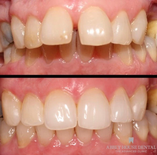 Before and After - Invisalign