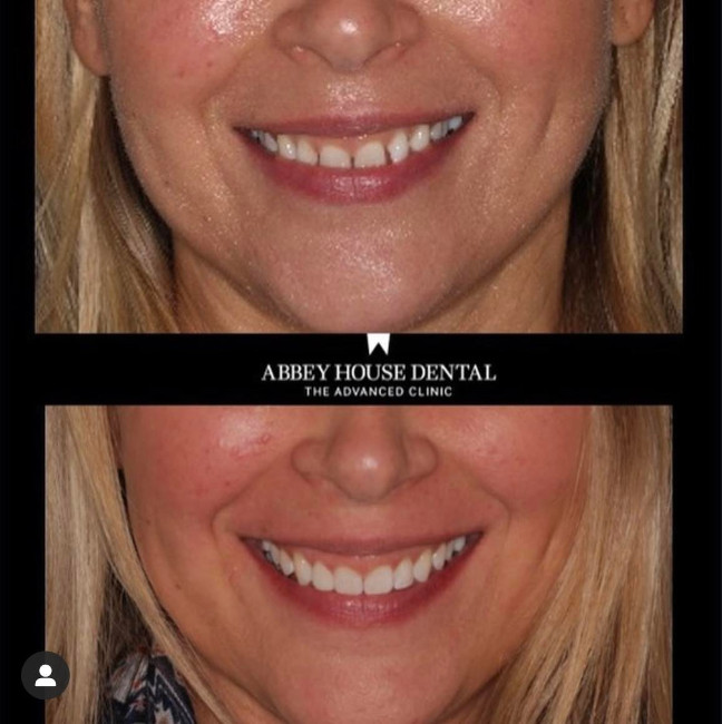 Before and After - Invisalign