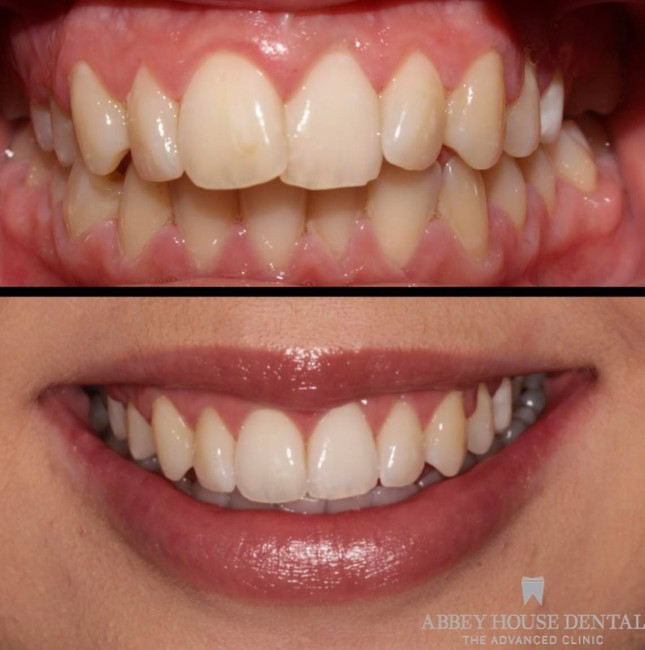 Before and After - Invisalign