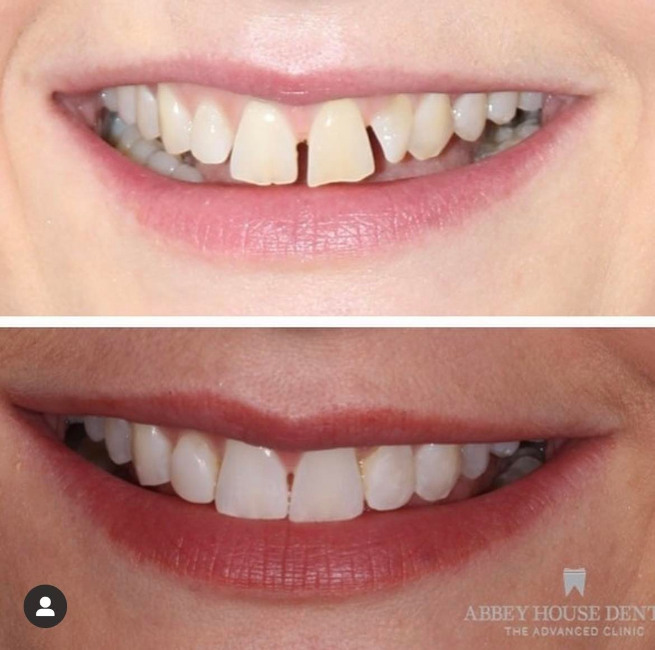 Before and After - Invisalign