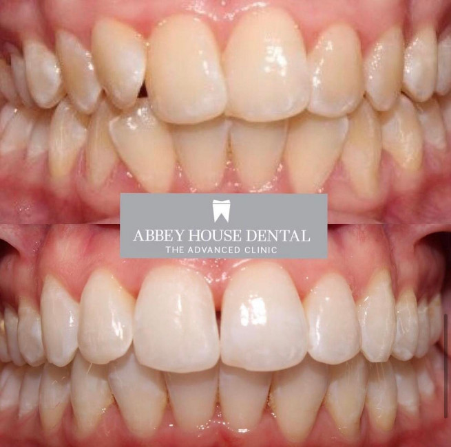 Before and After - Alignment + Whitening