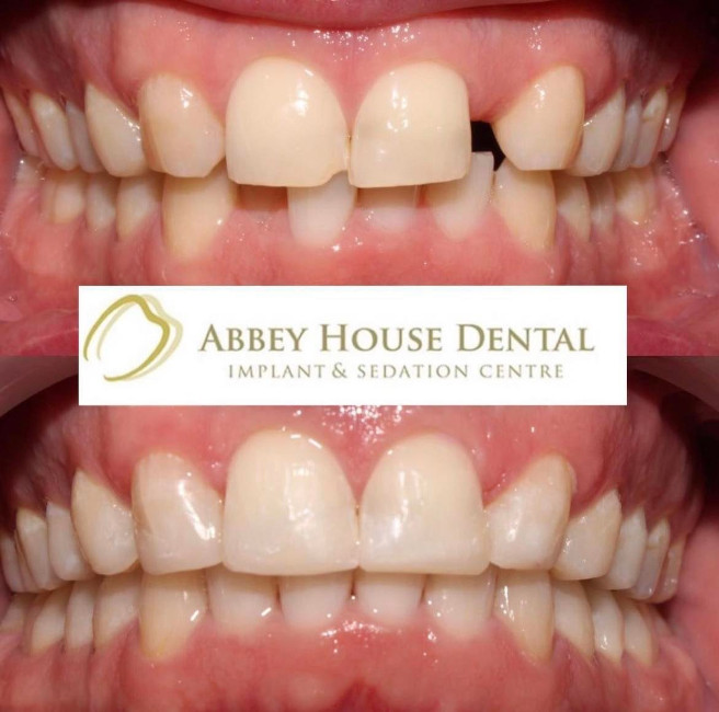 Before and After - Composite Edge Bonding + Alignment